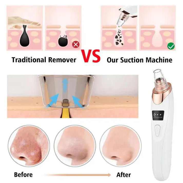 5 in 1 Black Head Remover machine Pimple Pore Cleaner Vacuum Suction Tool